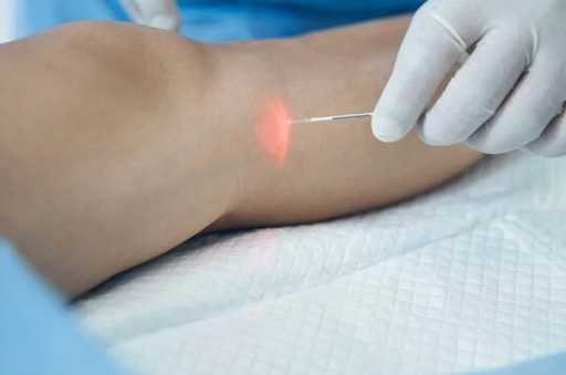 Varicose vein treatment by laser - Best solution for beauty