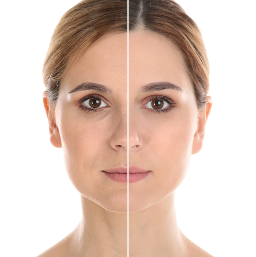 Fat transfers for the face: A natural approach to facial rejuvenation