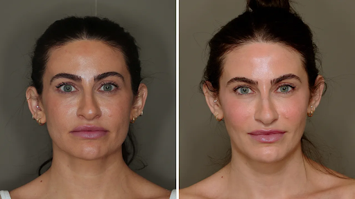Fat transfers for the face: A natural approach to facial rejuvenation