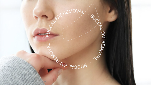 Buccal fat removal method