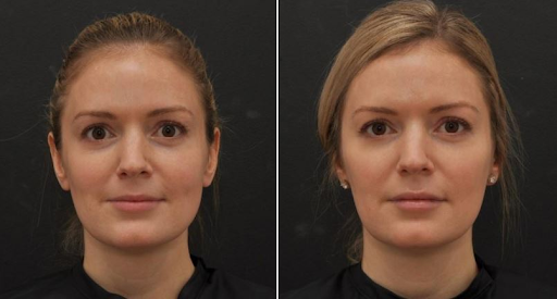 How long does botox injection last?