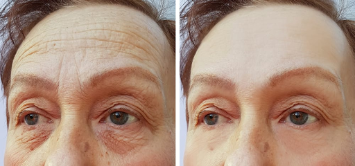 How long does botox injection last?
