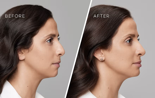 What types of fillers are there? Why should you choose Hyaluronic acid?