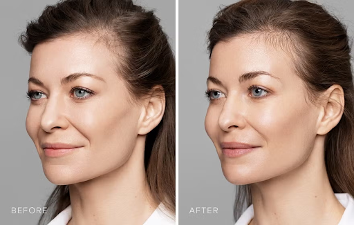 What types of fillers are there? Why should you choose Hyaluronic acid?