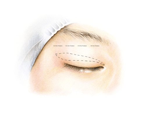 European eye aging improvement method