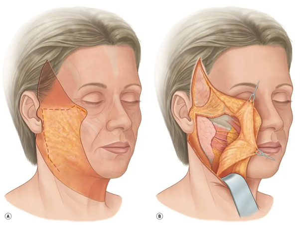 Deep Plane or SMAS Facelift