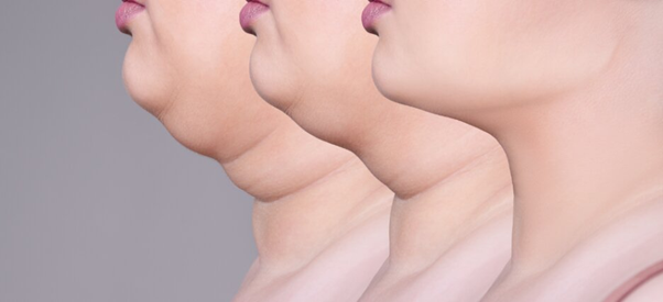 Chin Liposuction
