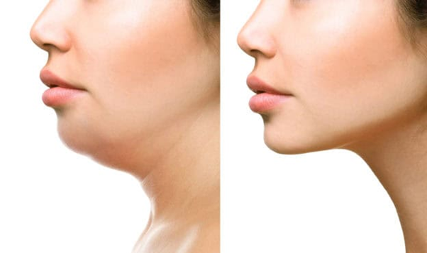 Chin Liposuction