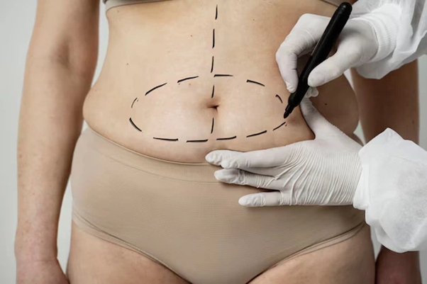 Vaser Liposuction
