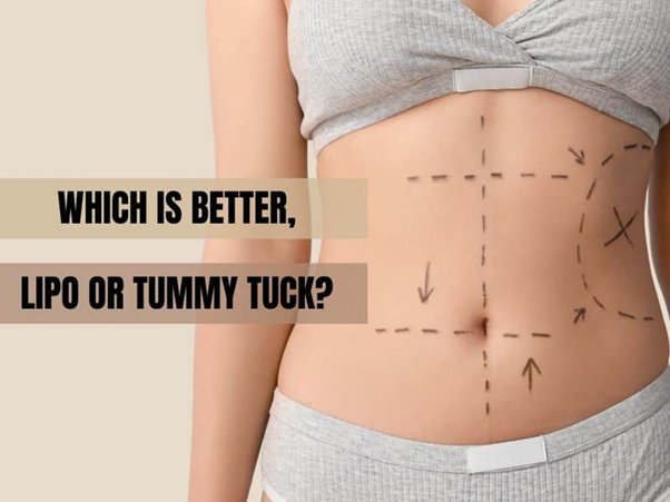 tummy tuck and liposuction