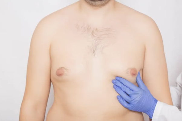 Gynecomastia Surgery