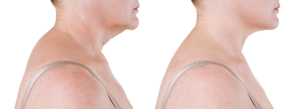Neck Lift Surgery