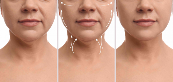 Neck Lift Surgery
