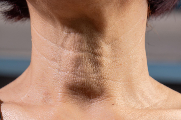 Neck Lift Surgery