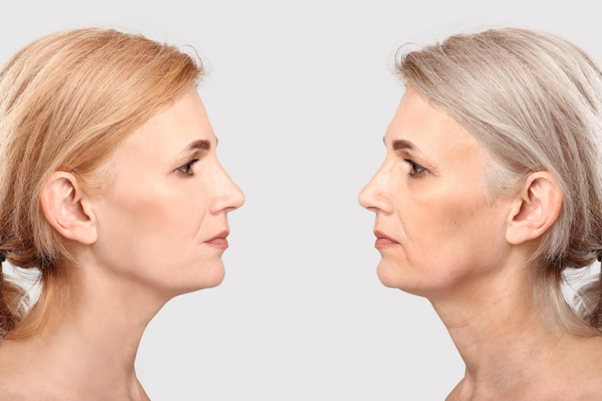 Facial aging
