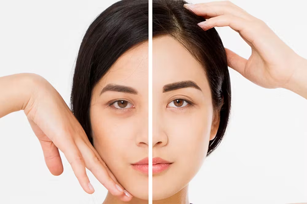 Botox vs Brow Lift
