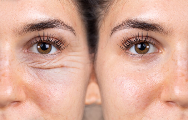 Lower Eyelid Bags